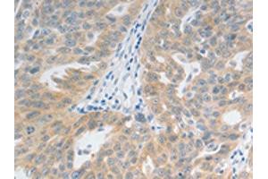The image on the left is immunohistochemistry of paraffin-embedded Human ovarian cancer tissue using ABIN7192728(TACR2 Antibody) at dilution 1/20, on the right is treated with synthetic peptide. (TACR2 抗体)