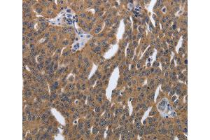 Immunohistochemistry of Human lung cancer using PDGFA Polyclonal Antibody at dilution of 1:40 (PDGFA 抗体)