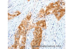 Immunohistochemistry of Human cervical cancer using ANXA8 Polyclonal Antibody at dilution of 1:35 (Annexin VIII 抗体)