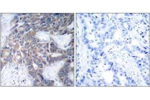 Immunohistochemistry analysis of paraffin-embedded human breast carcinoma, using MEK1/2 (Phospho-Ser217) Antibody. (MEK1/2 抗体  (pSer218))