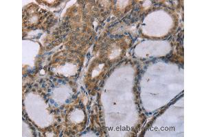 Immunohistochemistry of Human thyroid cancer using ACTN2 Polyclonal Antibody at dilution of 1:30