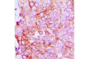 Immunohistochemical analysis of ATP1A1 staining in human breast cancer formalin fixed paraffin embedded tissue section. (ATP1A1 抗体  (N-Term))
