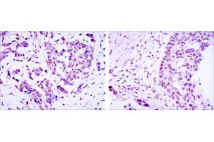 Immunohistochemical analysis of paraffin-embedded breast cancer (left) and ovarian cancer (right) using CRTC3 mouse mAb with DAB staining. (CRTC3 抗体)