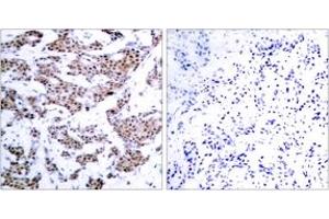 Immunohistochemistry analysis of paraffin-embedded human breast carcinoma, using MEF2A (Phospho-Thr312) Antibody. (MEF2A 抗体  (pThr312))
