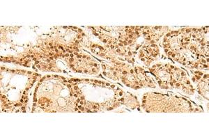 Immunohistochemistry of paraffin-embedded Human thyroid cancer tissue using POLH Polyclonal Antibody at dilution of 1:45(x200) (POLH 抗体)