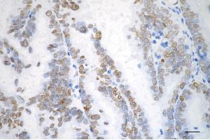 Immunohistochemistry was performed on paraffin-embedded human ovarian carcinoma using checkpoint kinase 2 antibody (ABIN7798039), 1:200). (Recombinant CHEK2 抗体)