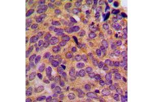 Immunohistochemical analysis of Cytokeratin 5 staining in human breast cancer formalin fixed paraffin embedded tissue section. (Cytokeratin 5 抗体  (C-Term))