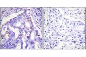 Immunohistochemistry analysis of paraffin-embedded human lung carcinoma tissue, using PIAS4 Antibody. (PIAS4 抗体  (AA 451-500))