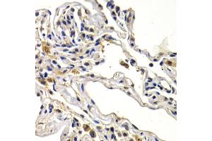 Immunohistochemistry of paraffin-embedded human lung cancer using WNT3A antibody (ABIN6292349) at dilution of 1:200 (40x lens). (WNT3A 抗体)