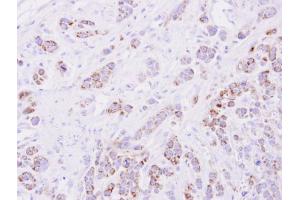 IHC-P Image Immunohistochemical analysis of paraffin-embedded MDA-MB-468 xenograft, using 15-PGDH, antibody at 1:500 dilution. (HPGD 抗体  (C-Term))