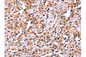 The image on the left is immunohistochemistry of paraffin-embedded Human thyroid cancer tissue using ABIN7191561(MYF5 Antibody) at dilution 1/15, on the right is treated with synthetic peptide. (MYF5 抗体)