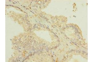 Immunohistochemistry of paraffin-embedded human prostate cancer using ABIN7151502 at dilution of 1:100 (ETFDH 抗体  (AA 34-617))
