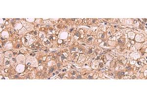 Immunohistochemistry of paraffin-embedded Human liver cancer tissue using PPP2R1A Polyclonal Antibody at dilution of 1:65(x200) (PPP2R1A 抗体)
