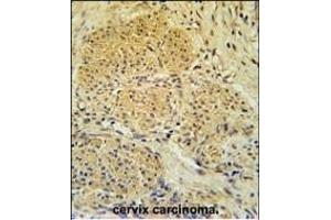 IPO7 Antibody (N-term) (ABIN651626 and ABIN2840333) immunohistochemistry analysis in formalin fixed and paraffin embedded human cervix carcinoma followed by peroxidase conjugation of the secondary antibody and DAB staining.