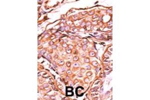Formalin-fixed and paraffin-embedded human cancer tissue reacted with the primary antibody, which was peroxidase-conjugated to the secondary antibody, followed by AEC staining. (C-JUN 抗体  (pSer63))