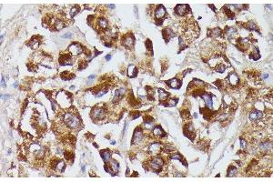Immunohistochemistry of paraffin-embedded Human liver cancer using AGT Polyclonal Antibody at dilution of 1:100 (40x lens). (AGT 抗体)
