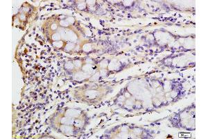 Formalin-fixed and paraffin embedded human colon carcinoma labeled with Anti-Clathrin heavy chain Polyclonal Antibody, Unconjugated (ABIN681883) at 1:200 followed by conjugation to the secondary antibody and DAB staining (Clathrin Heavy Chain (CLTC) (AA 401-500) 抗体)