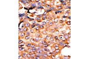 Formalin-fixed and paraffin-embedded human cancer tissue reacted with the primary antibody, which was peroxidase-conjugated to the secondary antibody, followed by AEC staining. (PANK3 抗体  (Middle Region))