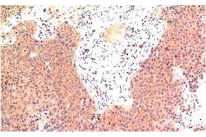 Immunohistochemistry of paraffin-embedded Human colon carcinoma tissue using Epsilon Tubulin Monoclonal Antibody at dilution of 1:200. (TUBE1 抗体)