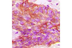Immunohistochemical analysis of PTTG1IP staining in human breast cancer formalin fixed paraffin embedded tissue section. (PTTG1IP 抗体  (Center))