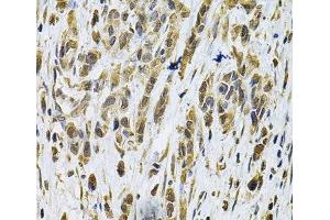 Immunohistochemistry of paraffin-embedded Human gastric cancer using RhoA Polyclonal Antibody at dilution of 1:100 (40x lens). (RHOA 抗体)