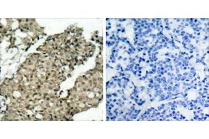 P-Peptide - +Immunohistochemical analysis of paraffin-embedded human breast carcinoma tissue using G3BP-1 (phospho-Ser232) antibody.