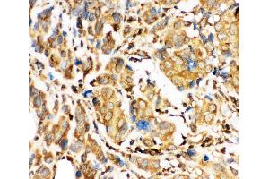 Anti-Bid Picoband antibody,  IHC(P): Human Mammary Cancer Tissue (BID 抗体  (AA 1-195))