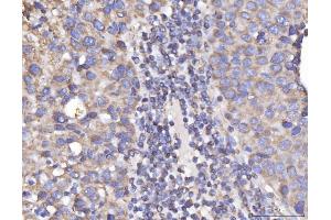 IHC analysis of DLST using anti-DLST antibody (ABIN7599412). (DLST 抗体  (AA 1-453))