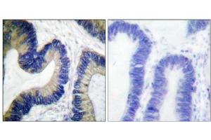 mmunohistochemical analysis of paraffin-embedded human colon carcinoma tissue using 4E-BP1 (Phospho-Ser64) antibody. (eIF4EBP1 抗体  (pSer64))