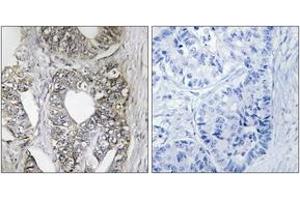 Immunohistochemistry analysis of paraffin-embedded human breast carcinoma tissue, using SAPK/JNK (Ab-183) Antibody. (SAPK, JNK (AA 166-215) 抗体)