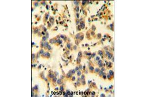 K0090 Antibody immunohistochemistry analysis in formalin fixed and paraffin embedded human testis carcinoma followed by peroxidase conjugation of the secondary antibody and DAB staining. (KIAA0090 抗体  (C-Term))