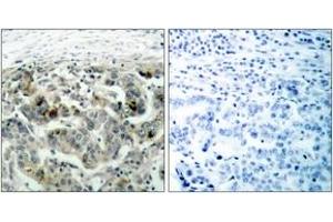 Immunohistochemistry analysis of paraffin-embedded human breast carcinoma tissue, using NF-kappaB p105/p50 (Ab-907) Antibody. (NFKB1 抗体  (AA 874-923))
