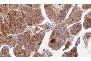 ABIN6277026 at 1/100 staining Human liver cancer tissue by IHC-P. (CD73 抗体  (N-Term))