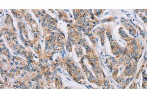 Immunohistochemistry of paraffin-embedded Human prostate cancer tissue using ATP2C1 Polyclonal Antibody at dilution 1:50 (ATP2C1 抗体)