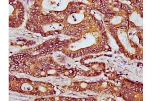 IHC image of ABIN7165641 diluted at 1:300 and staining in paraffin-embedded human colon cancer performed on a Leica BondTM system. (HOOK3 抗体  (AA 357-455))