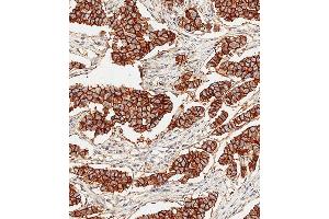 Immunohistochemical analysis of paraffin-embedded Human breast carcinoma tissue using E performed on the Leica® BOND RXm. (ErbB2/Her2 抗体)