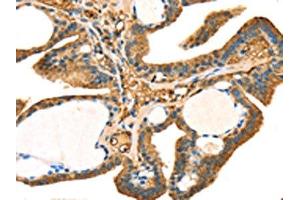 The image on the left is immunohistochemistry of paraffin-embedded Human thyroid cancer tissue using ABIN7131239(STX18 Antibody) at dilution 1/25, on the right is treated with fusion protein. (Syntaxin 18 抗体)