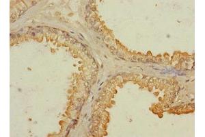Immunohistochemistry of paraffin-embedded human prostate cancer using ABIN7167139 at dilution of 1:100 (RASSF6 抗体  (AA 1-303))