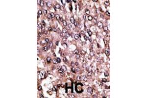 Formalin-fixed and paraffin-embedded human cancer tissue reacted with the primary antibody, which was peroxidase-conjugated to the secondary antibody, followed by AEC staining. (MAGEC1 抗体  (C-Term))