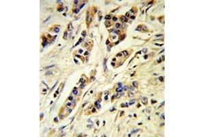 Human breast carcinoma (formalin-fixed, paraffin-embedded) reacted with IL10 Antibody , which was peroxidase-conjugated to the secondary antibody, followed by DAB staining. (IL-10 抗体  (Middle Region))