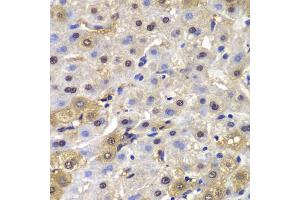 Immunohistochemistry of paraffin-embedded human liver cancer using MAD1L1 antibody. (MAD1L1 抗体)