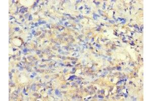 Immunohistochemistry of paraffin-embedded human gastric cancer using ABIN7175332 at dilution of 1:100 (VTA1 抗体  (AA 23-307))