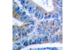 Immunohistochemical analysis of BCLX (pS62) staining in human colon cancer formalin fixed paraffin embedded tissue section.