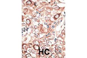 Formalin-fixed and paraffin-embedded human hepatocellular carcinoma tissue reacted with GJB2 polyclonal antibody  , which was peroxidase-conjugated to the secondary antibody, followed by DAB staining. (GJB2 抗体  (C-Term))