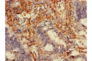 Immunohistochemistry of paraffin-embedded human colon cancer using ABIN7159304 at dilution of 1:100 (Melanophilin 抗体  (AA 310-539))