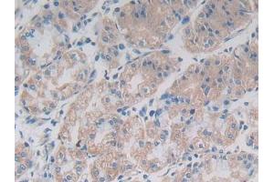 DAB staining on IHC-P; Samples: Human Breast cancer Tissue) (TLR1 抗体  (AA 114-339))
