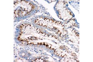 Anti-Mannose 6 Phosphate Receptor(Cation independent) antibody, IHC(P) IHC(P): Human Intestinal Cancer Tissue (IGF2R 抗体  (C-Term))