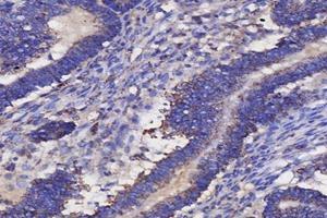 Immunohistochemistry analysis of paraffin-embedded human ovarian cancer using IL-3RB (ABIN7073557) at dilution of 1: 4000 (CD131 抗体)