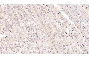 Detection of MBP in Human Liver cancer Tissue using Monoclonal Antibody to Major Basic Protein (MBP) (Major Basic Protein 抗体  (AA 105-222))