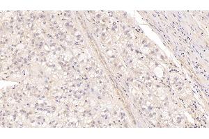 Detection of MBP in Human Liver cancer Tissue using Monoclonal Antibody to Major Basic Protein (MBP) (Major Basic Protein 抗体  (AA 105-222))